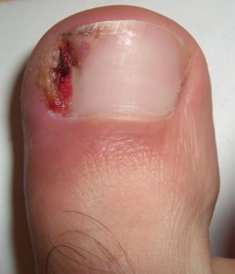 Ingrown_nail_002